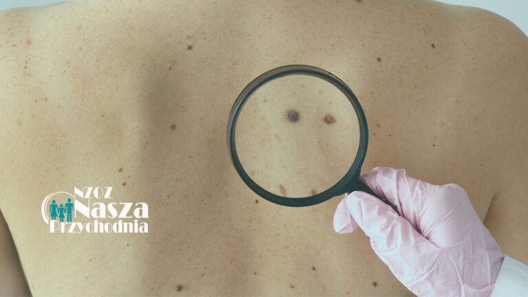Czerniak darmowe badania